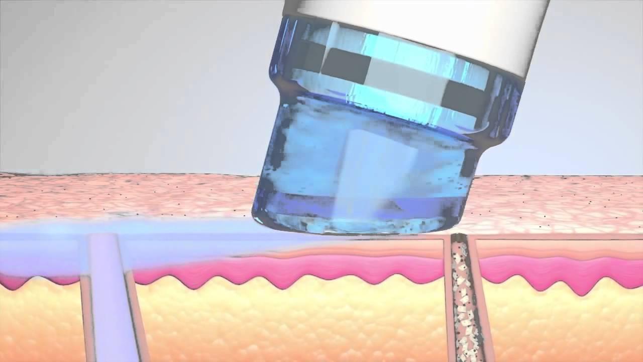 Hydrafacial